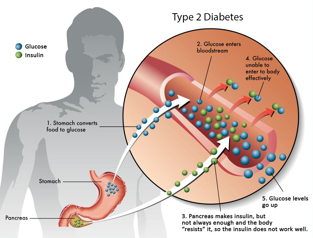 Diabetes A taste for sweets that’s so deadly Philippines Graphic